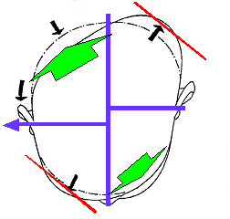 Representación de un craneo de bebé con distintos tipos de plagiocefalia